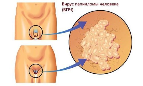 Лечение остроконечных кондилом радионож