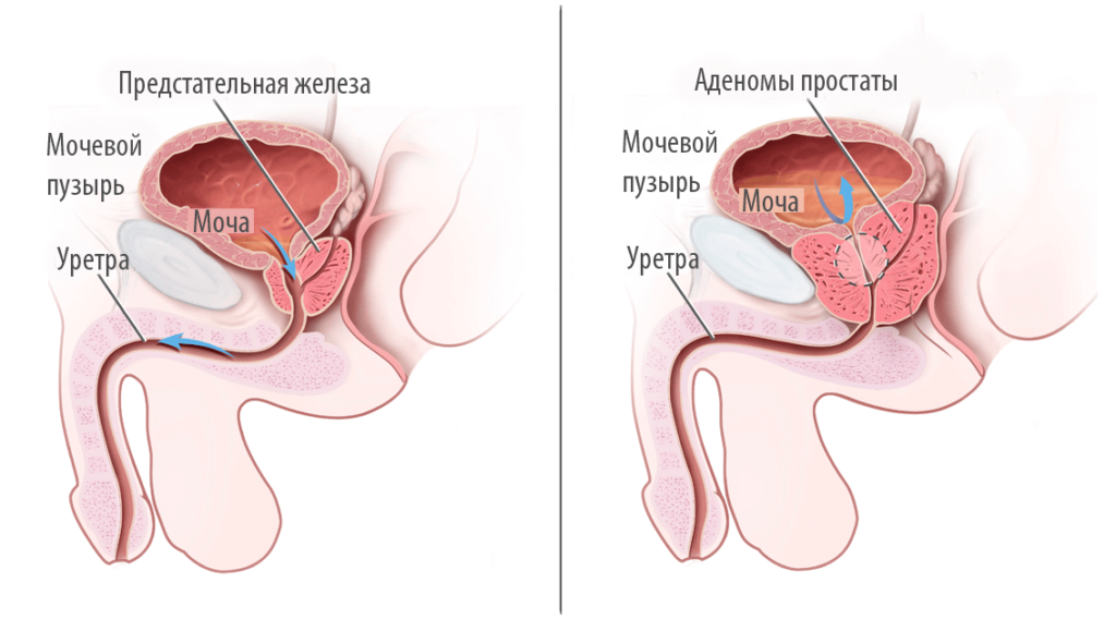 УЗИ простаты, узи предстательной железы УЗИ простаты, узи предстательной железы