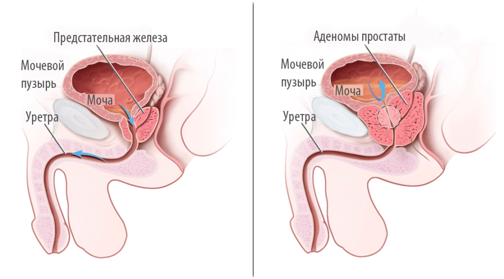 УЗИ простаты, узи предстательной железы 